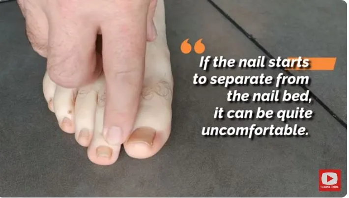 atasi jamur di kuku kaki berbagai sumber