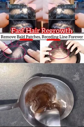 Mengatasi rambut botak area dahi Berbagai sumber