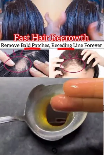 Mengatasi rambut botak area dahi Berbagai sumber