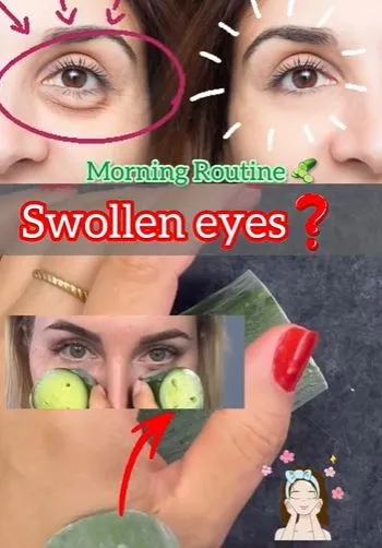 Atasi mata bengkak dan sembap pakai timun Berbagai sumber