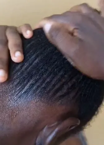 Hempas ketombe dan gatal di kepala Berbagai sumber