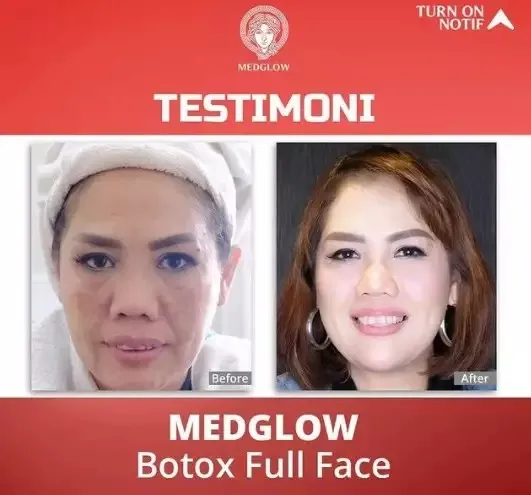 Seleb sebelum dan sesudah suntik botoks Berbagai sumber