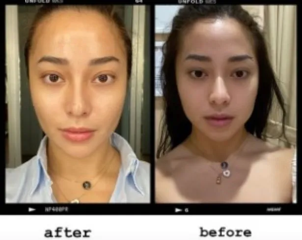 Seleb sebelum dan sesudah suntik botoks Berbagai sumber