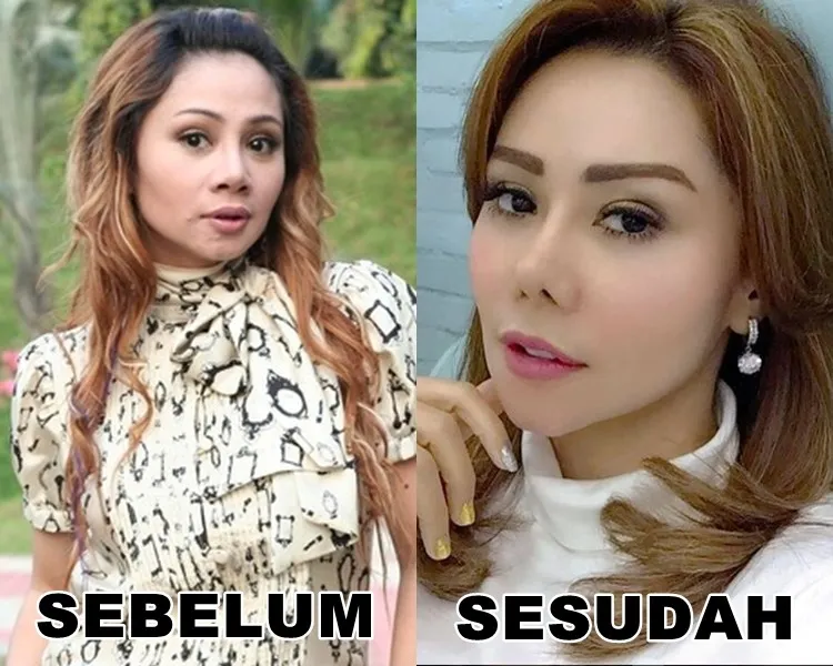 Seleb sebelum dan sesudah suntik botoks Berbagai sumber