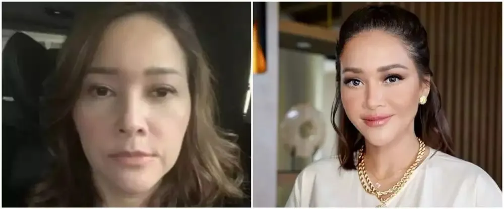 Seleb sebelum dan sesudah suntik botoks Berbagai sumber