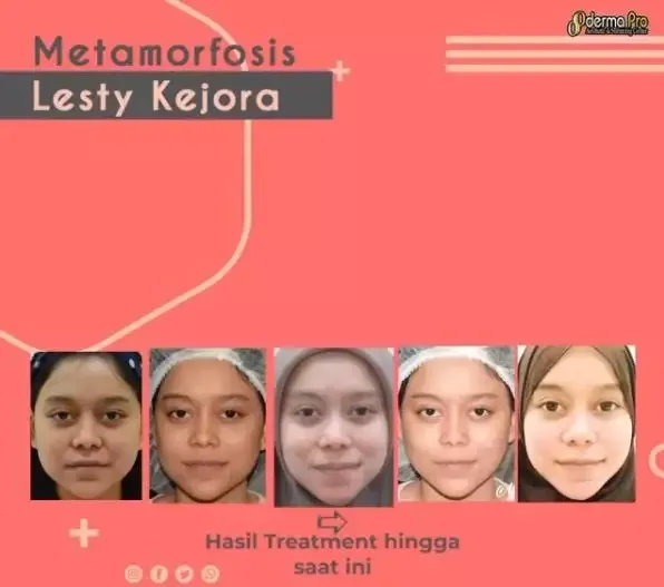 Seleb sebelum dan sesudah suntik botoks Berbagai sumber