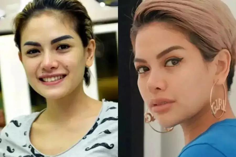 Seleb sebelum dan sesudah suntik botoks Berbagai sumber