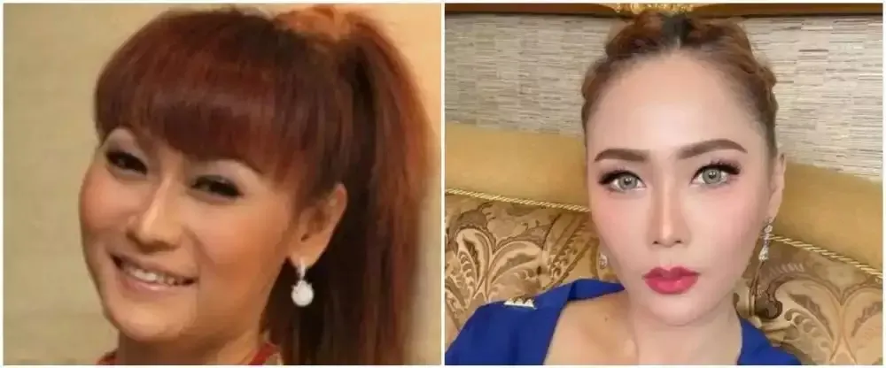 Seleb sebelum dan sesudah suntik botoks Berbagai sumber