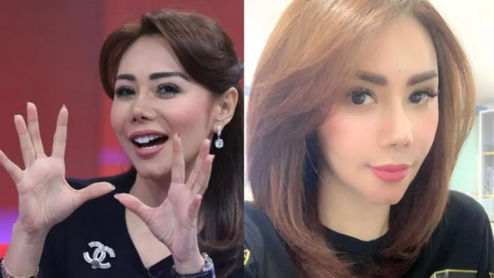 seleb sebelum dan sesudah filler bibir berbagai sumber