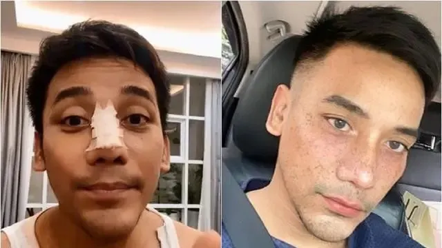 13 potret wajah seleb perubahan dagu Berbagai sumber