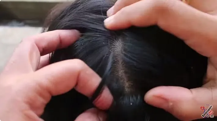 cara menghilangkan ketombe berkerak berbagai sumber