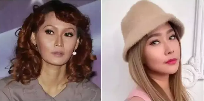 Sebelum dan sesudah tanam benang berbagai sumber Sebelum dan sesudah tanam benang berbagai sumber