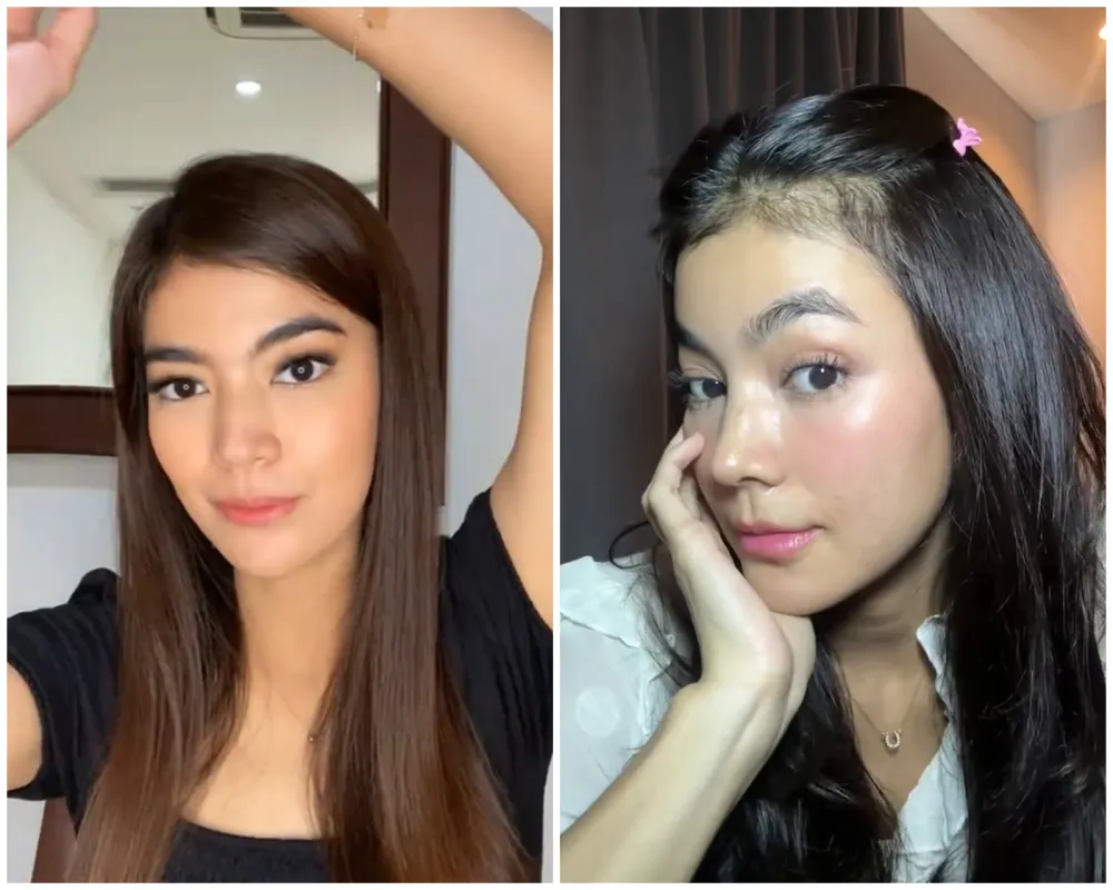 before-after Raya Kohandi usai jalani operasi © Instagram