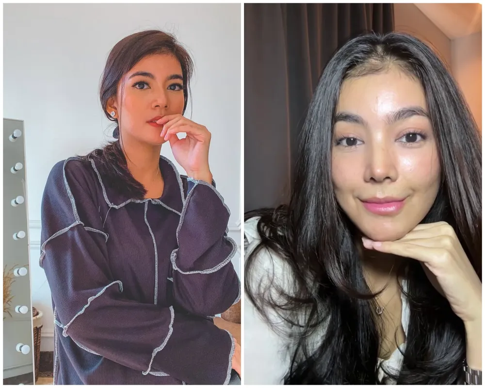 before-after Raya Kohandi usai jalani operasi © Instagram