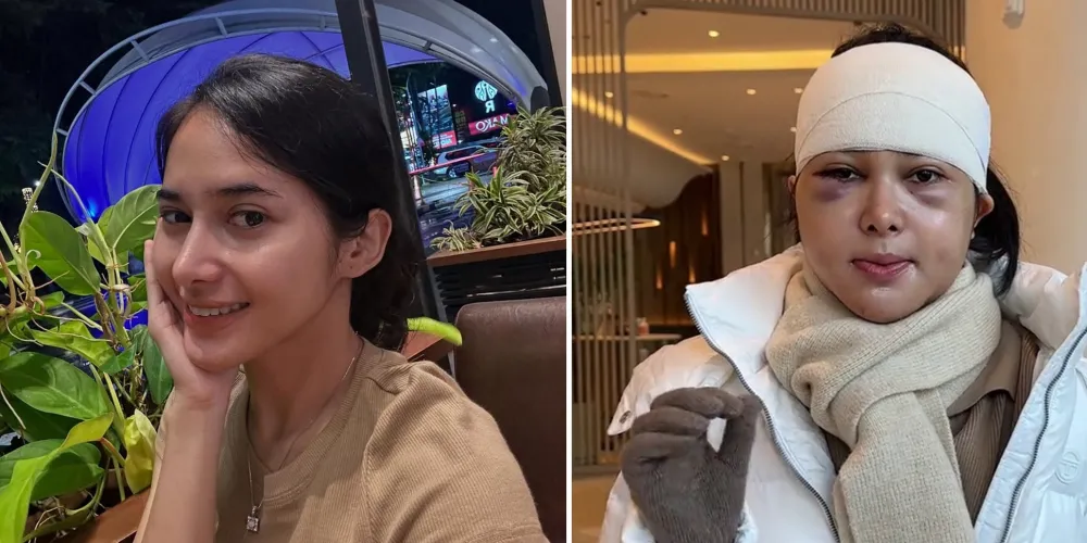 pilih oplas meski sudah cantik alami © 2025 brilio.net pilih oplas meski sudah cantik alami © 2025 brilio.net