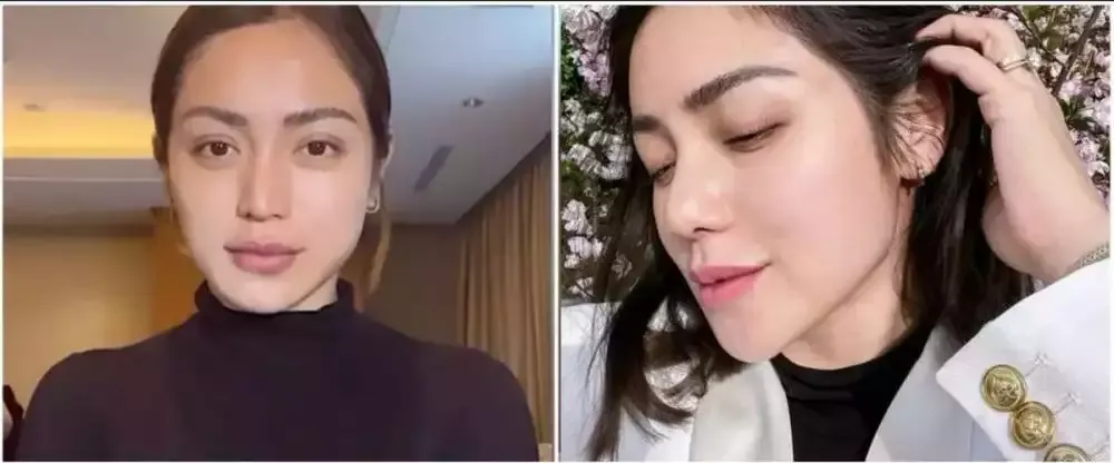 pilih oplas meski sudah cantik alami © 2025 brilio.net pilih oplas meski sudah cantik alami © 2025 brilio.net