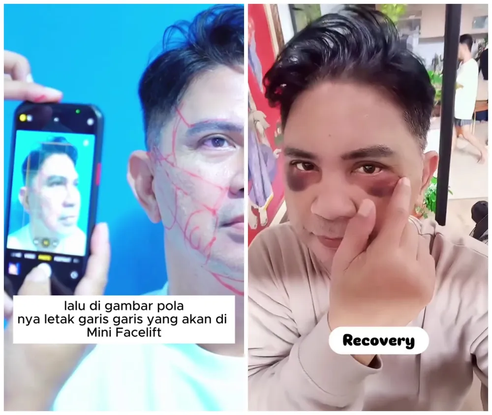 before-after Ronnie Sianturi © Instagram