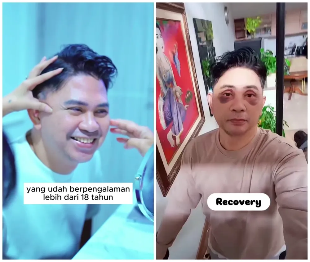 before-after Ronnie Sianturi © Instagram