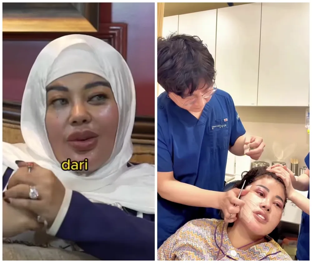 Shindy Samuel sebelum dan sesudah operasi plastik © Instagram Shindy Samuel sebelum dan sesudah operasi plastik © Instagram