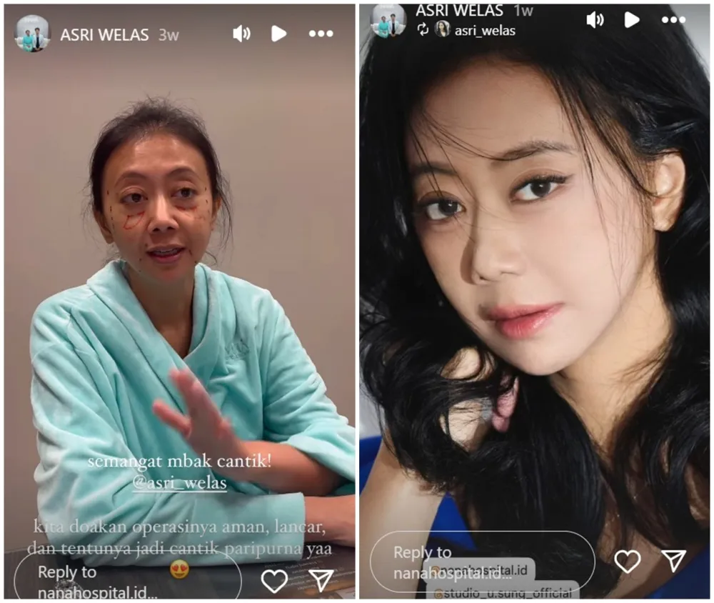 before-after Asri Welas © Instagram before-after Asri Welas © Instagram