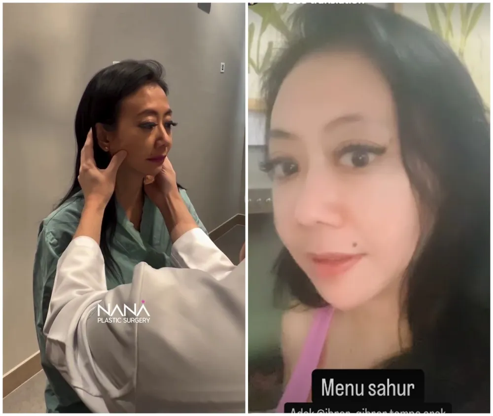 before-after Asri Welas © Instagram before-after Asri Welas © Instagram