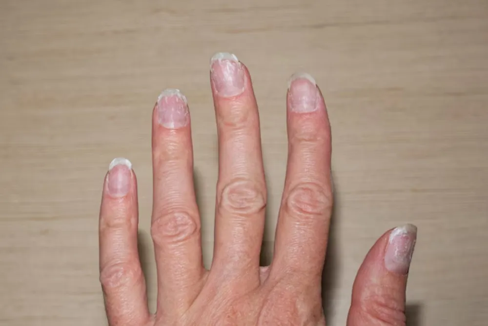 Kuku sering patah dan jamuran © Instagram