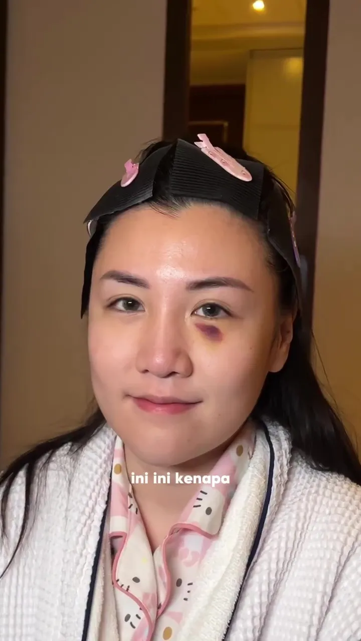 Punya bekas memar di wajah © Instagram Punya bekas memar di wajah © Instagram