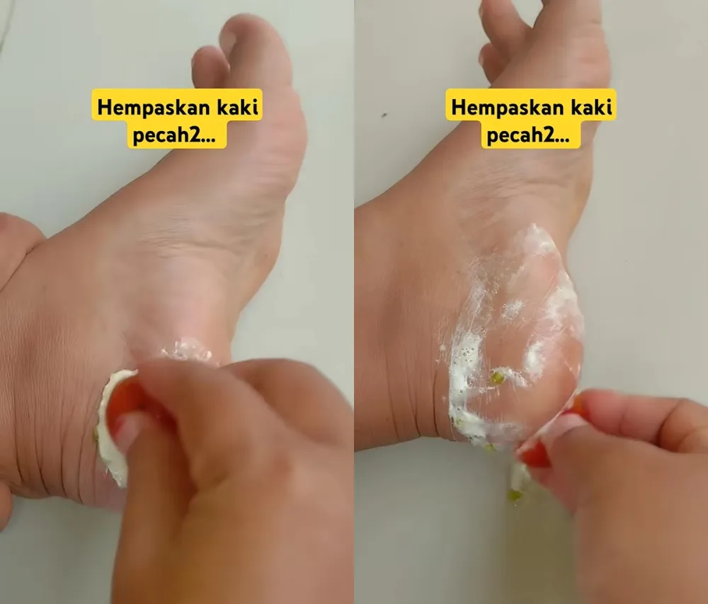 Tak ada lagi tumit kasar © YouTube