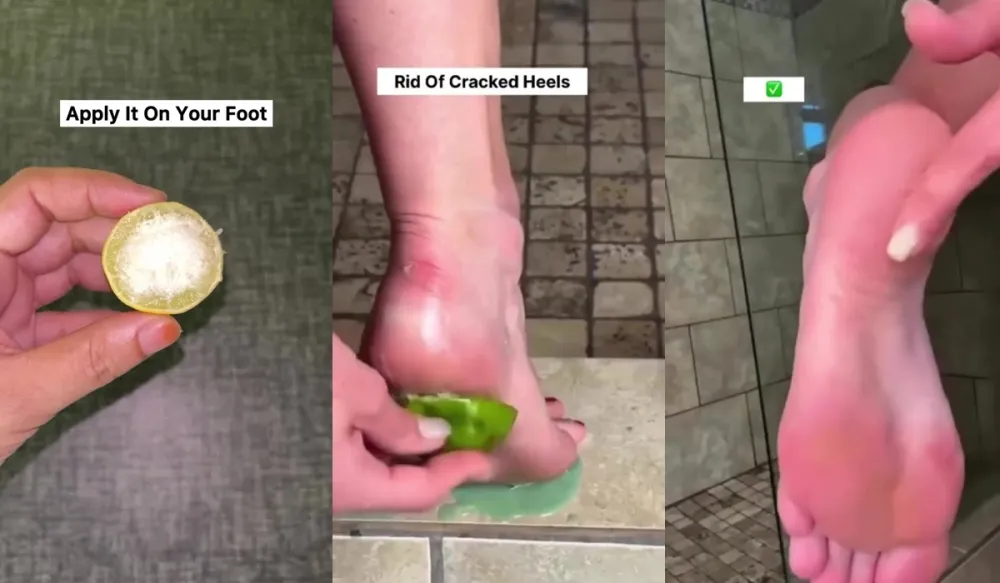 Tumit pecah-pecah © Instagram 